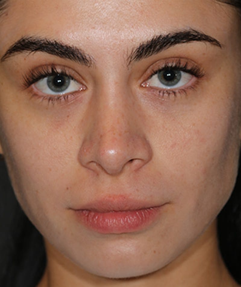 Primary Rhinoplasty Before & After Gallery - Patient 108142641 - Image 4