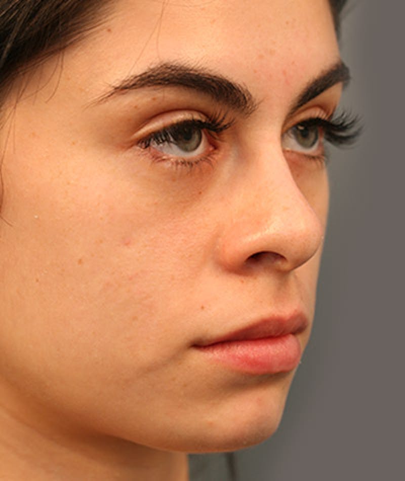 Primary Rhinoplasty Before & After Gallery - Patient 108142641 - Image 5