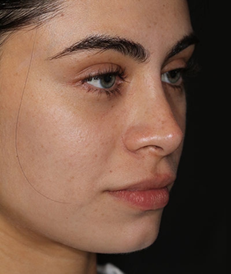 Primary Rhinoplasty Before & After Gallery - Patient 108142641 - Image 6