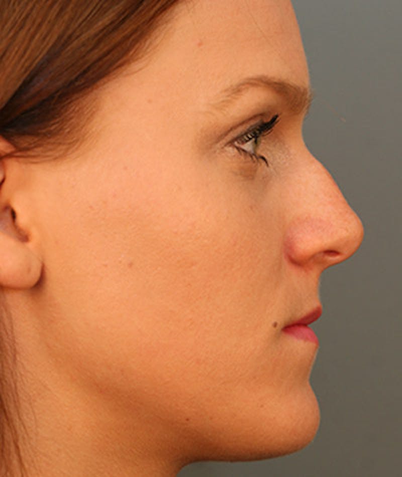 Primary Rhinoplasty Before & After Gallery - Patient 108142646 - Image 1