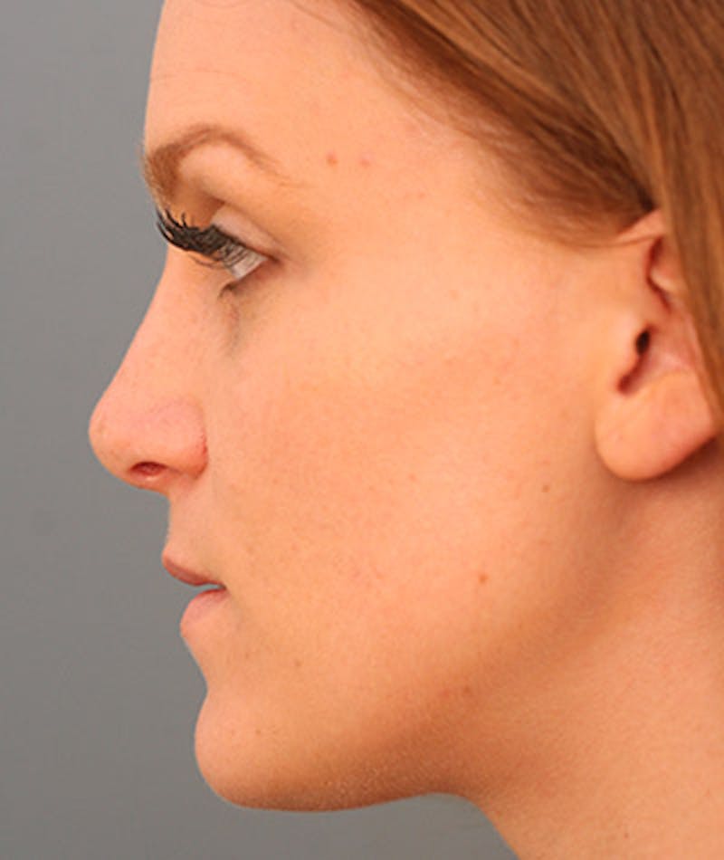 Primary Rhinoplasty Before & After Gallery - Patient 108142646 - Image 2