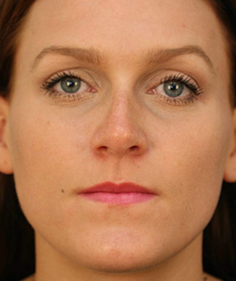 Primary Rhinoplasty Before & After Gallery - Patient 108142646 - Image 3