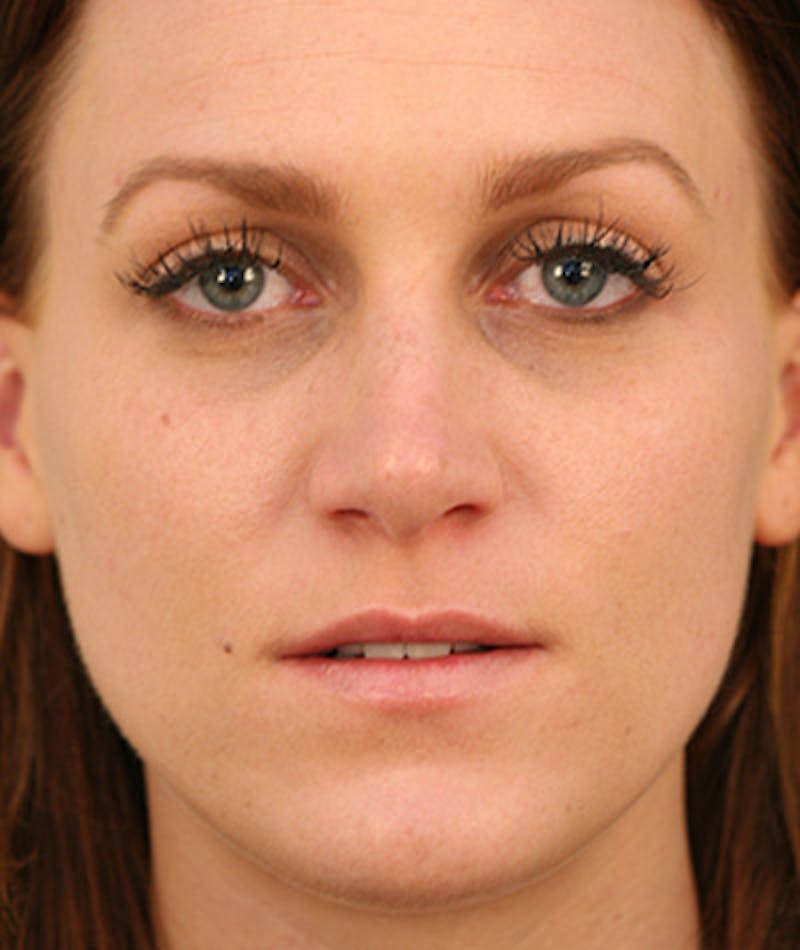 Primary Rhinoplasty Before & After Gallery - Patient 108142646 - Image 4