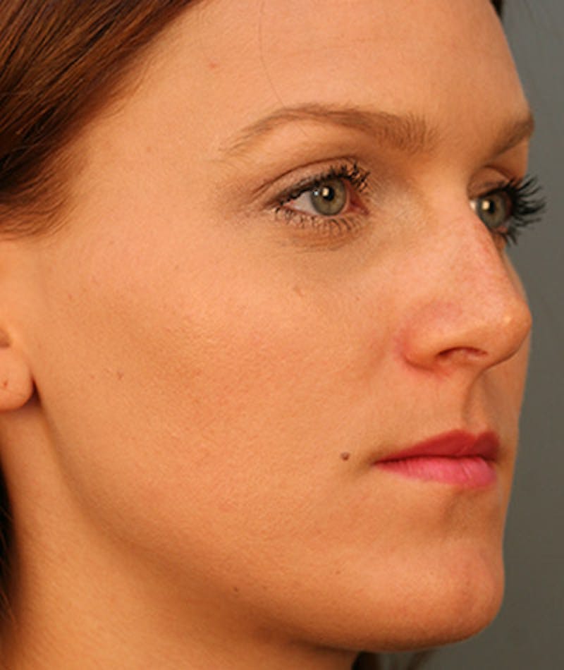 Primary Rhinoplasty Before & After Gallery - Patient 108142646 - Image 5