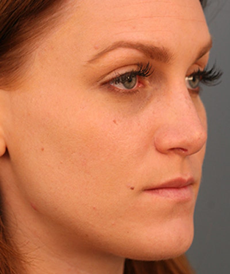 Primary Rhinoplasty Before & After Gallery - Patient 108142646 - Image 6