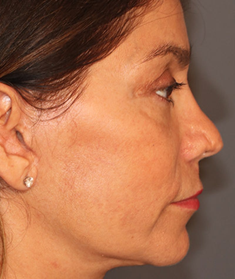 Primary Rhinoplasty Before & After Gallery - Patient 108142653 - Image 1