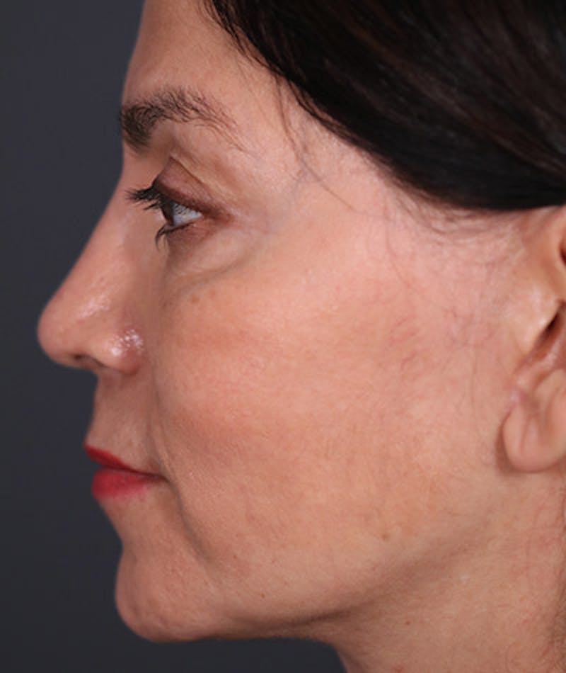 Primary Rhinoplasty Before & After Gallery - Patient 108142653 - Image 2