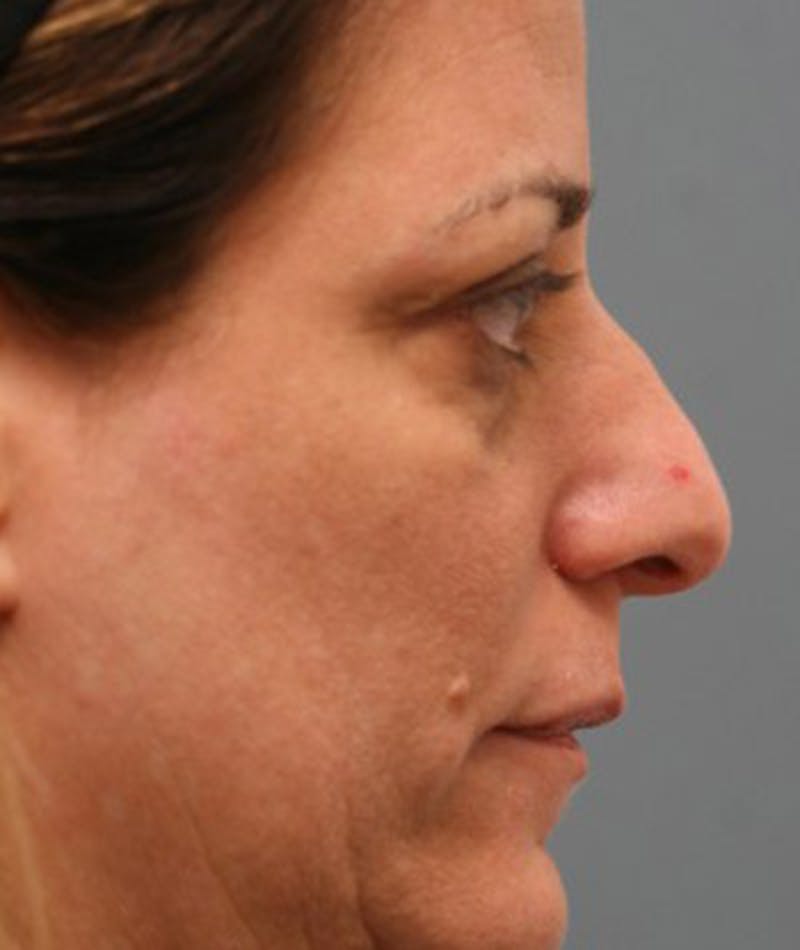 Primary Rhinoplasty Before & After Gallery - Patient 108142665 - Image 1