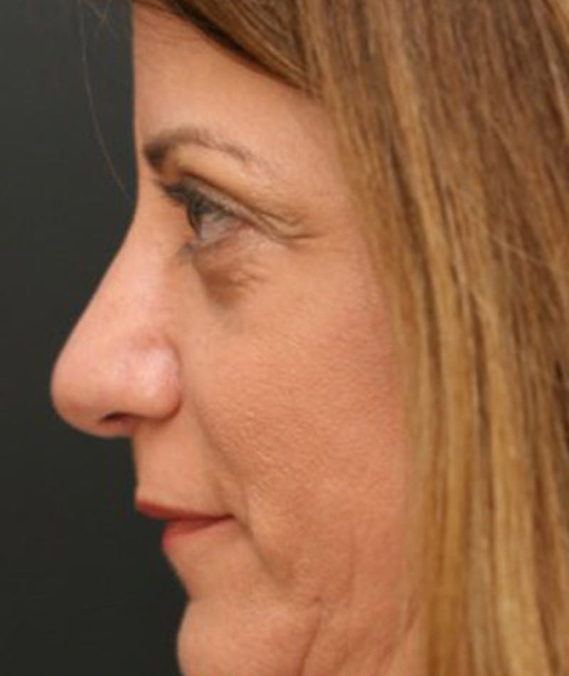 Primary Rhinoplasty Before & After Gallery - Patient 108142665 - Image 2