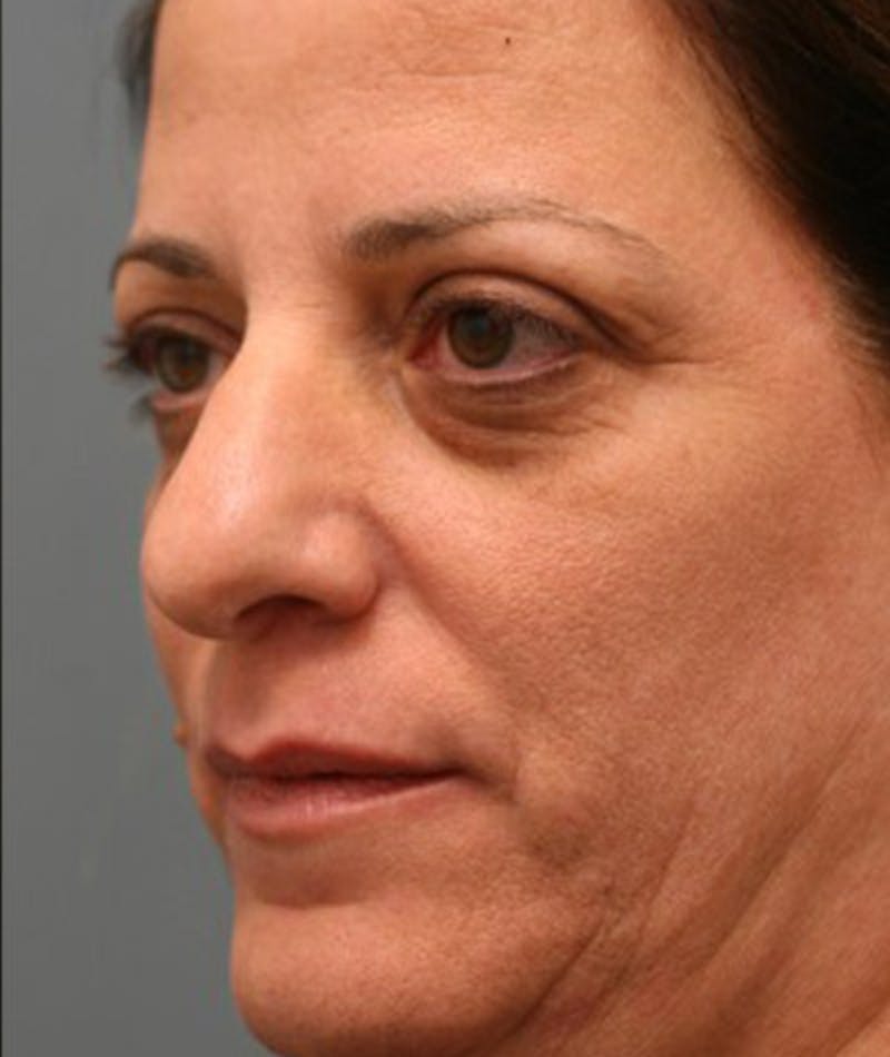 Primary Rhinoplasty Before & After Gallery - Patient 108142665 - Image 3