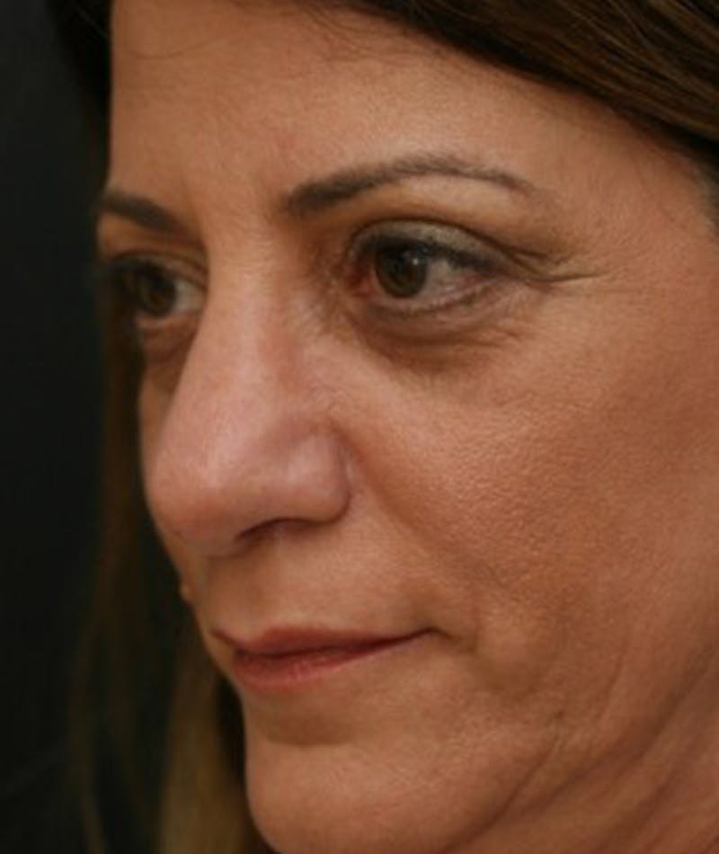 Primary Rhinoplasty Before & After Gallery - Patient 108142665 - Image 4
