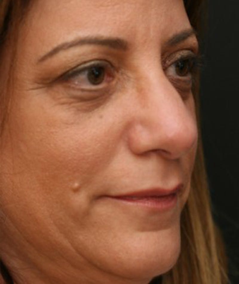 Primary Rhinoplasty Before & After Gallery - Patient 108142665 - Image 6