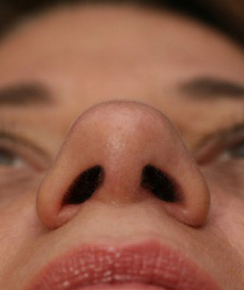 Primary Rhinoplasty Before & After Gallery - Patient 108142665 - Image 8