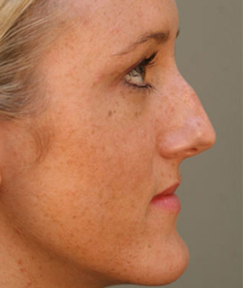 Primary Rhinoplasty Before & After Gallery - Patient 108157153 - Image 1