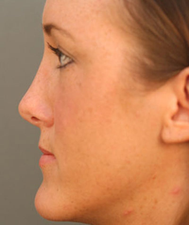 Primary Rhinoplasty Before & After Gallery - Patient 108157153 - Image 2
