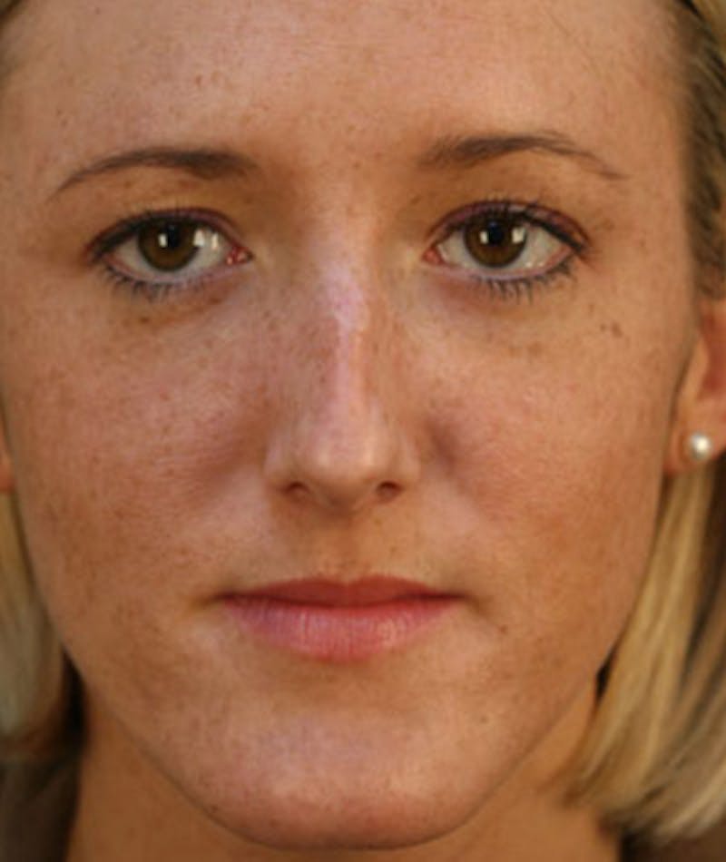 Primary Rhinoplasty Before & After Gallery - Patient 108157153 - Image 3