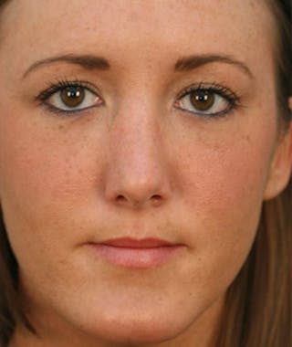 Primary Rhinoplasty Before & After Gallery - Patient 108157153 - Image 4