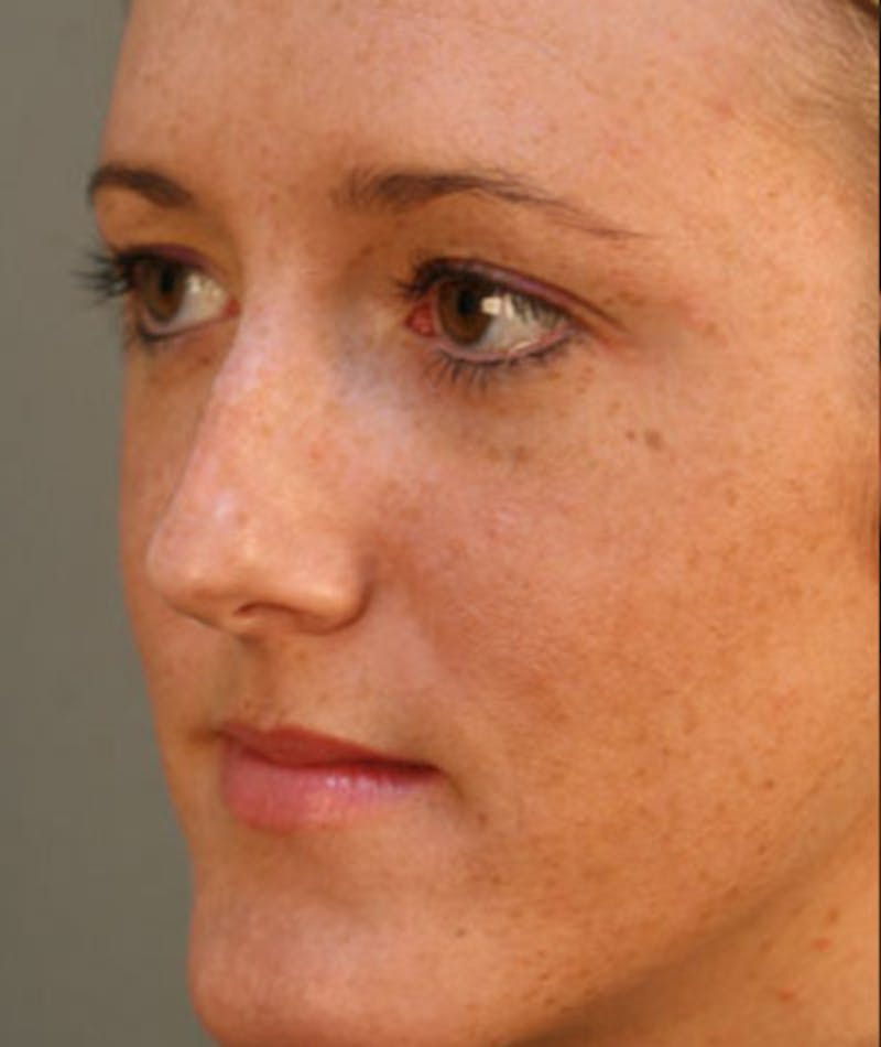 Primary Rhinoplasty Before & After Gallery - Patient 108157153 - Image 5