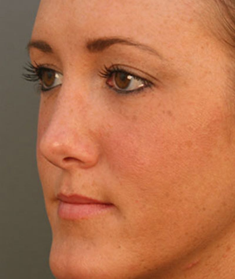 Primary Rhinoplasty Before & After Gallery - Patient 108157153 - Image 6