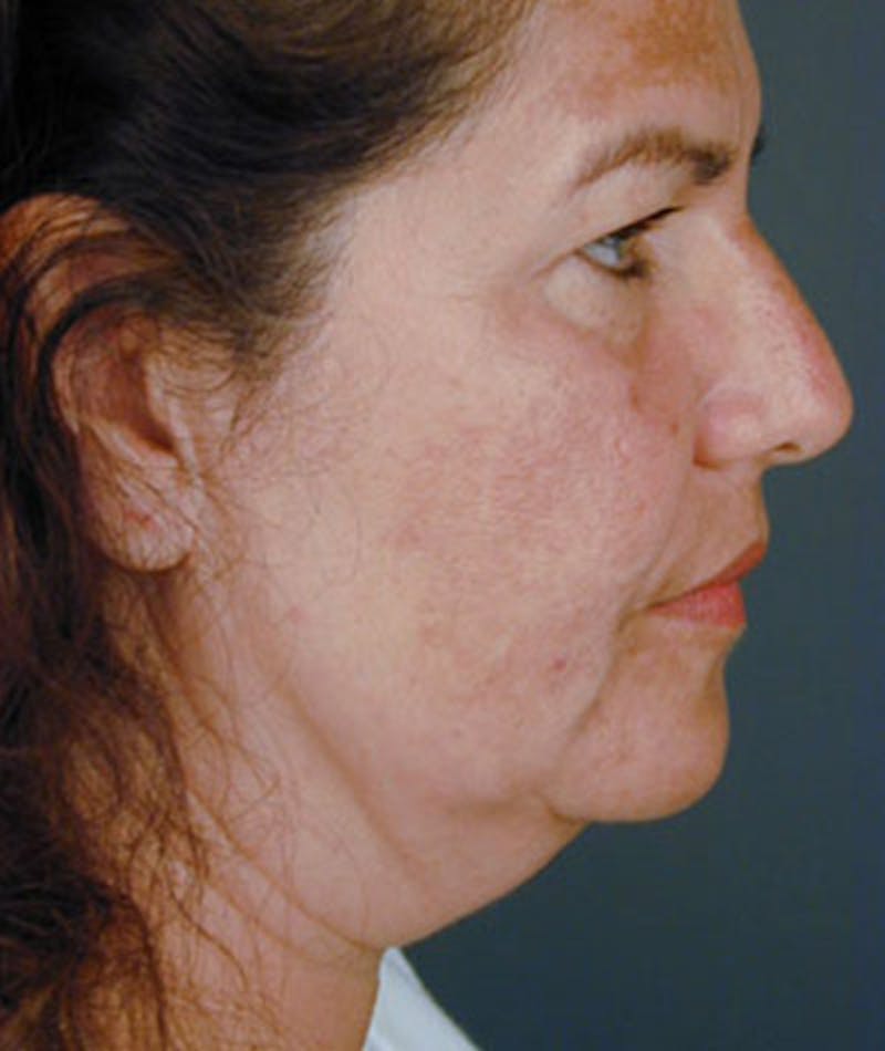 Primary Rhinoplasty Before & After Gallery - Patient 108157159 - Image 1