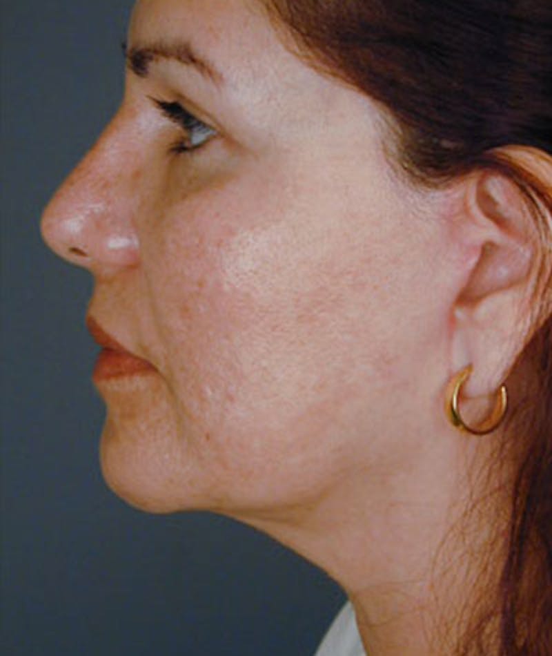 Primary Rhinoplasty Before & After Gallery - Patient 108157159 - Image 2