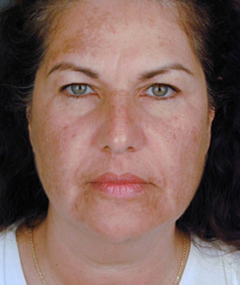 Primary Rhinoplasty Before & After Gallery - Patient 108157159 - Image 3