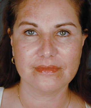 Primary Rhinoplasty Before & After Gallery - Patient 108157159 - Image 4