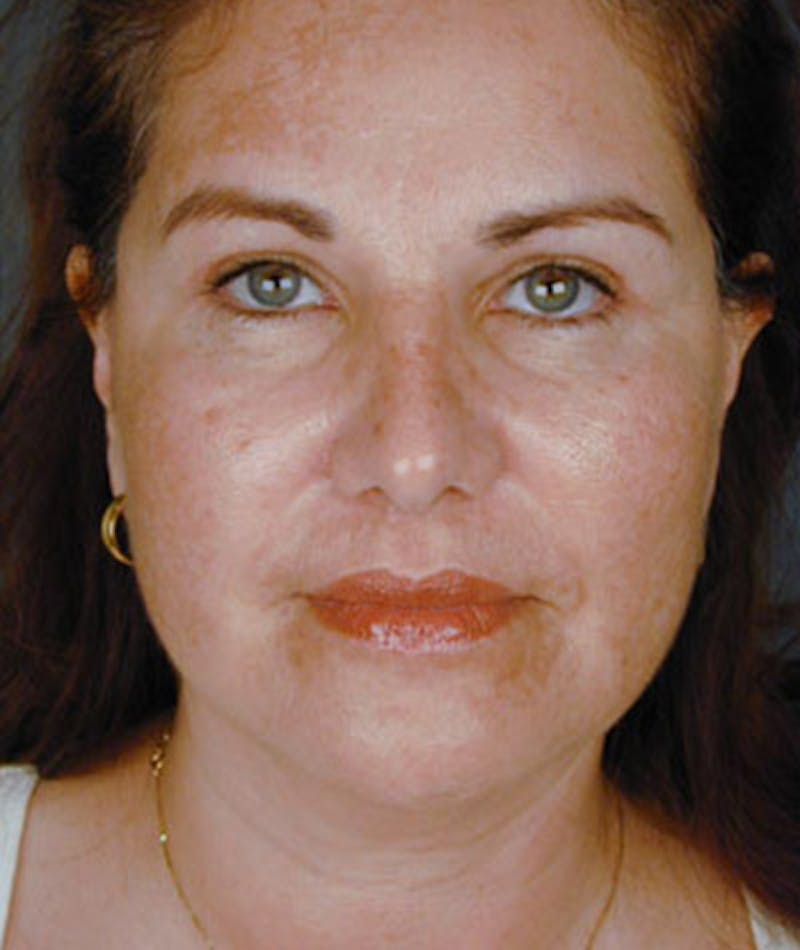 Primary Rhinoplasty Before & After Gallery - Patient 108157159 - Image 4