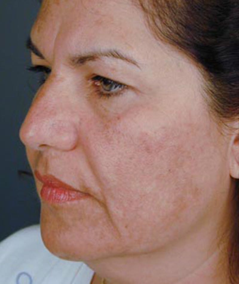 Primary Rhinoplasty Before & After Gallery - Patient 108157159 - Image 5