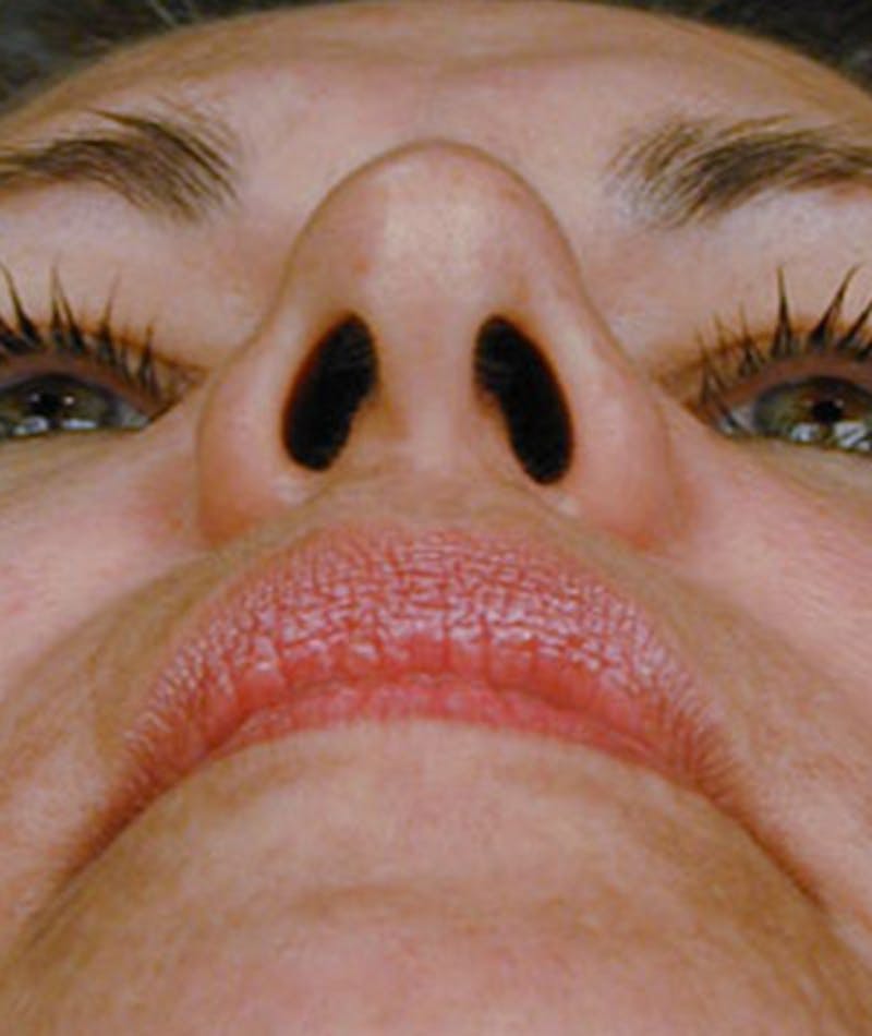 Primary Rhinoplasty Before & After Gallery - Patient 108157159 - Image 7