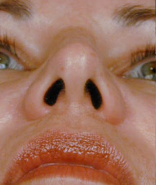 Primary Rhinoplasty Before & After Gallery - Patient 108157159 - Image 8