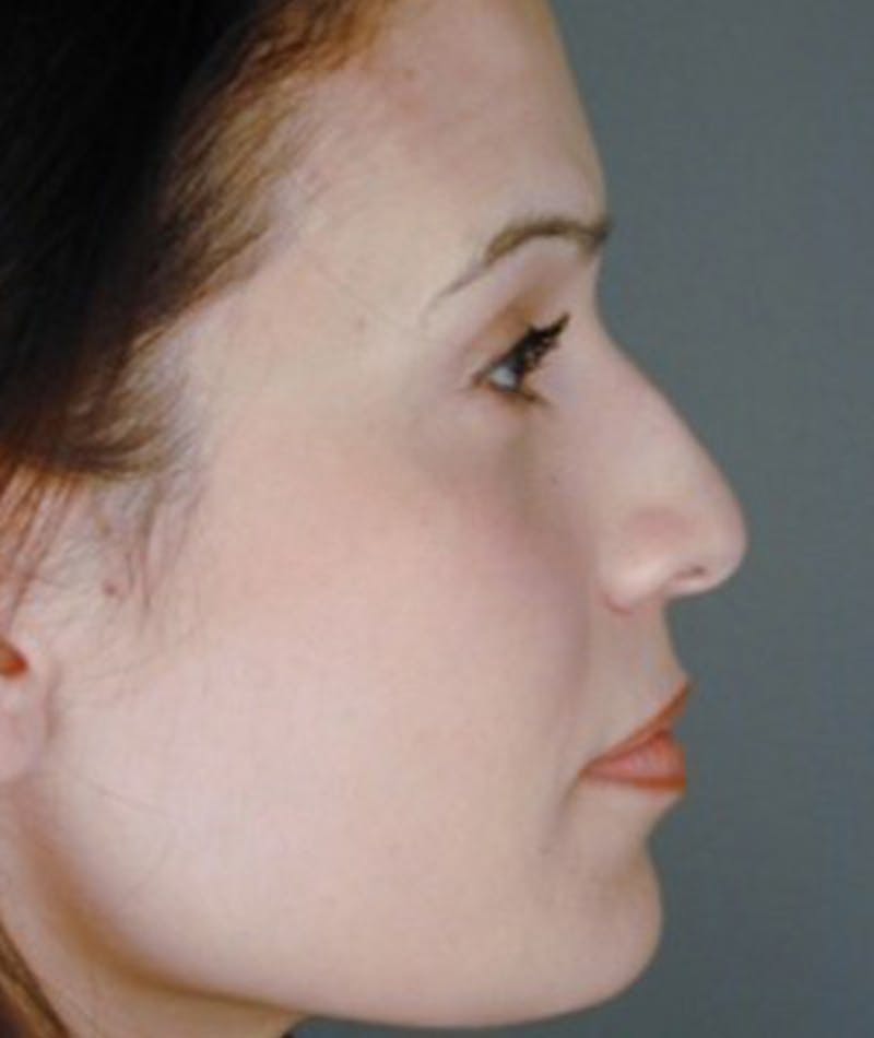 Primary Rhinoplasty Before & After Gallery - Patient 108171647 - Image 1