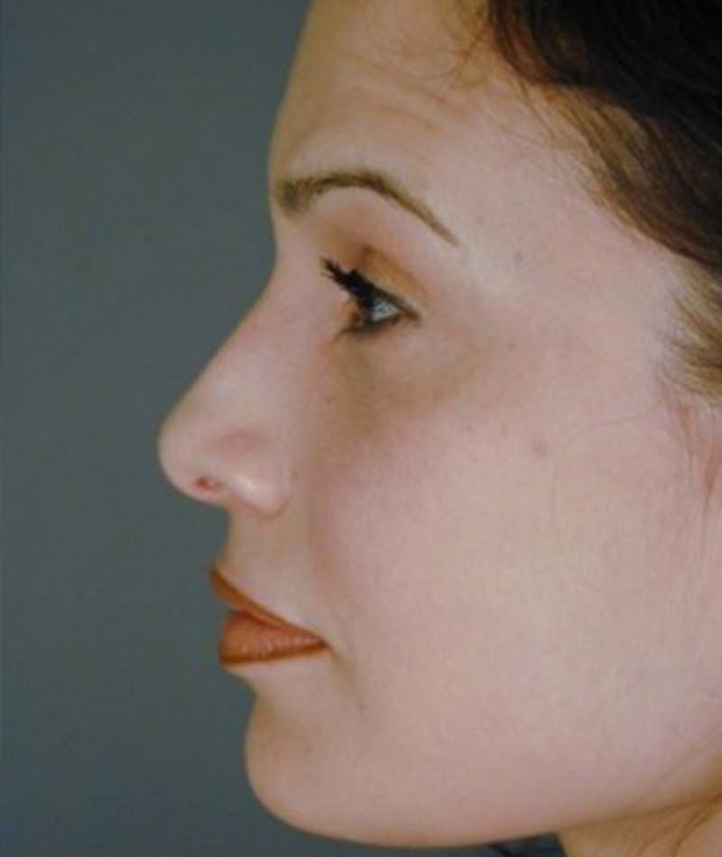 Primary Rhinoplasty Before & After Gallery - Patient 108171647 - Image 2