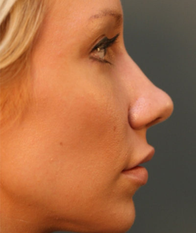 Primary Rhinoplasty Before & After Gallery - Patient 108171680 - Image 1