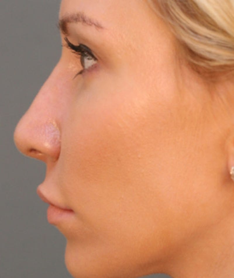 Primary Rhinoplasty Before & After Gallery - Patient 108171680 - Image 2