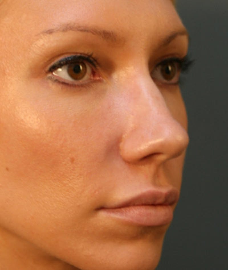 Primary Rhinoplasty Before & After Gallery - Patient 108171680 - Image 3