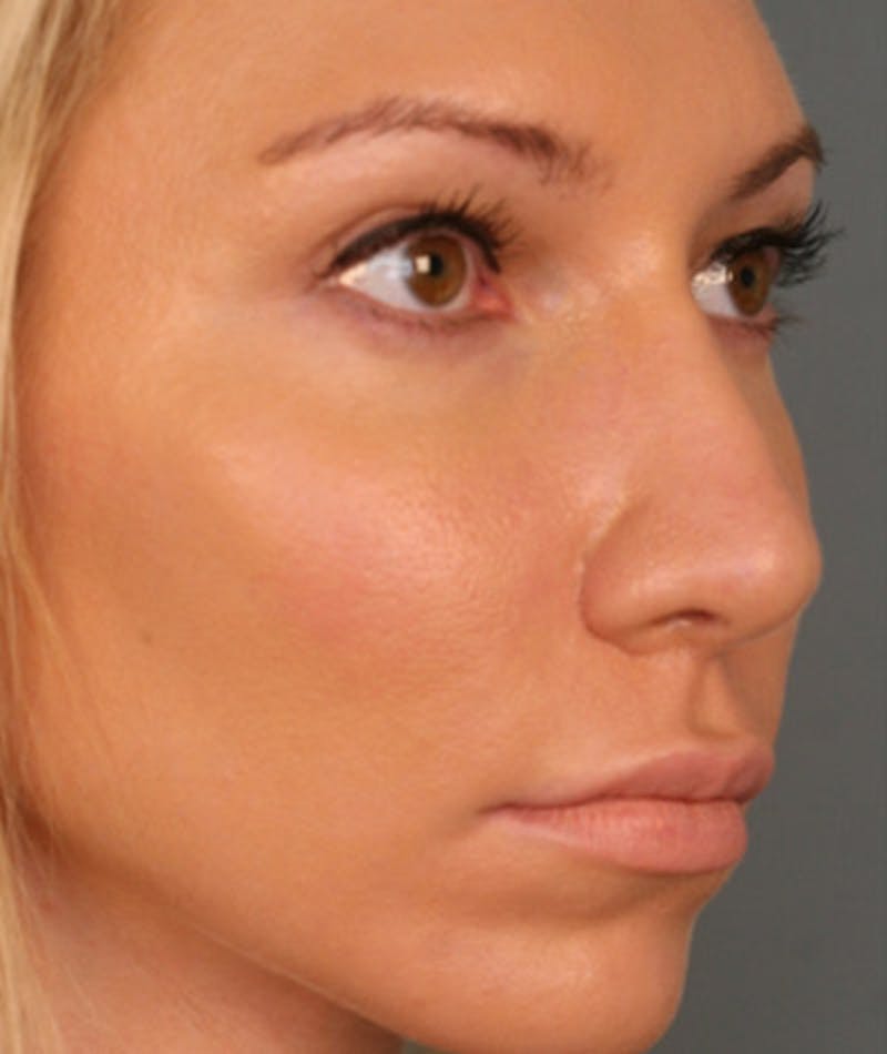 Primary Rhinoplasty Before & After Gallery - Patient 108171680 - Image 4