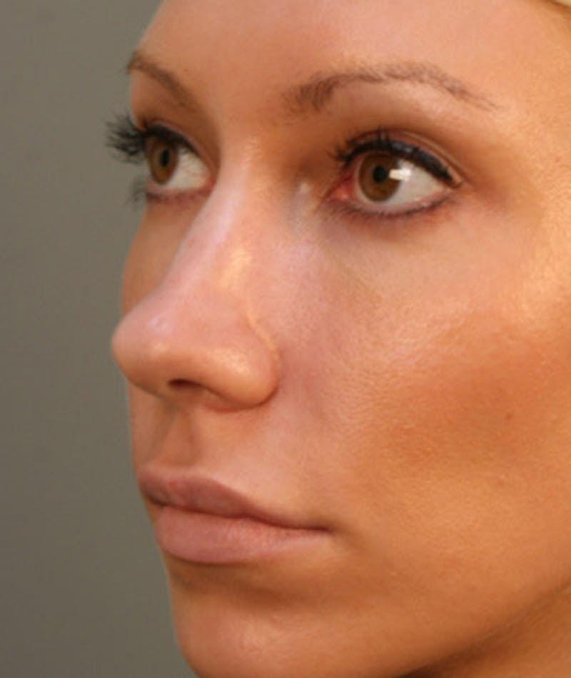 Primary Rhinoplasty Before & After Gallery - Patient 108171680 - Image 5