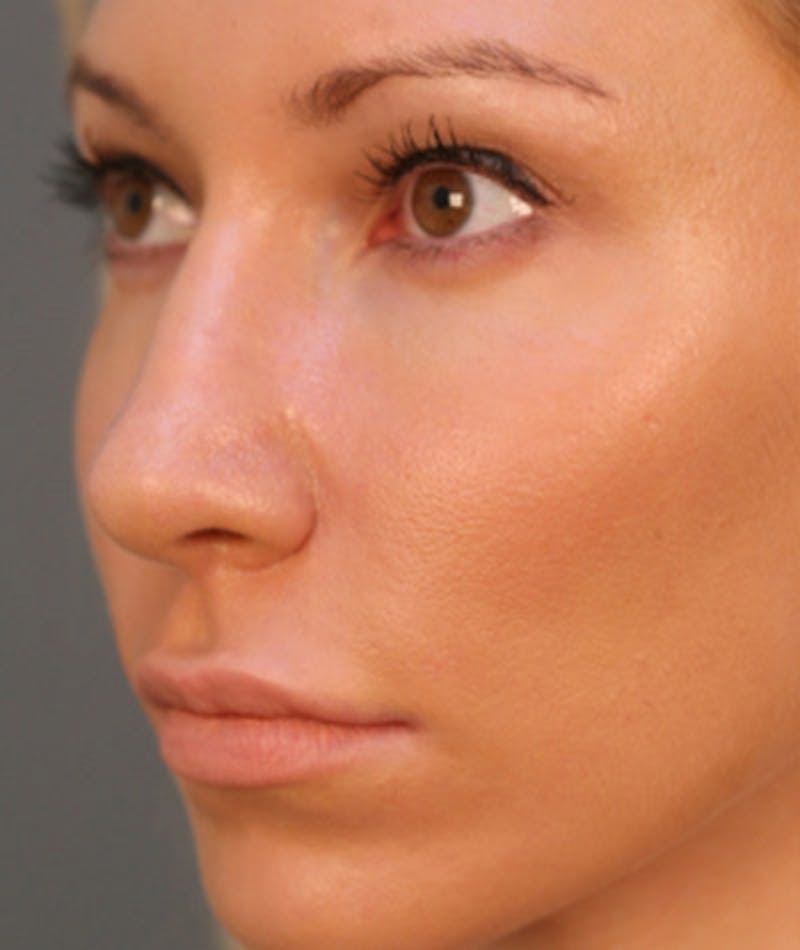 Primary Rhinoplasty Before & After Gallery - Patient 108171680 - Image 6