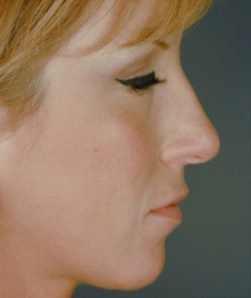 Primary Rhinoplasty Before & After Gallery - Patient 108171681 - Image 1