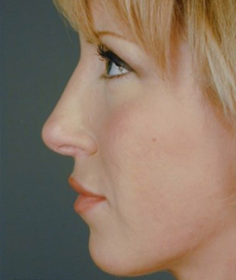 Primary Rhinoplasty Before & After Gallery - Patient 108171681 - Image 2