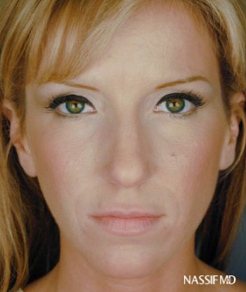 Primary Rhinoplasty Before & After Gallery - Patient 108171681 - Image 3