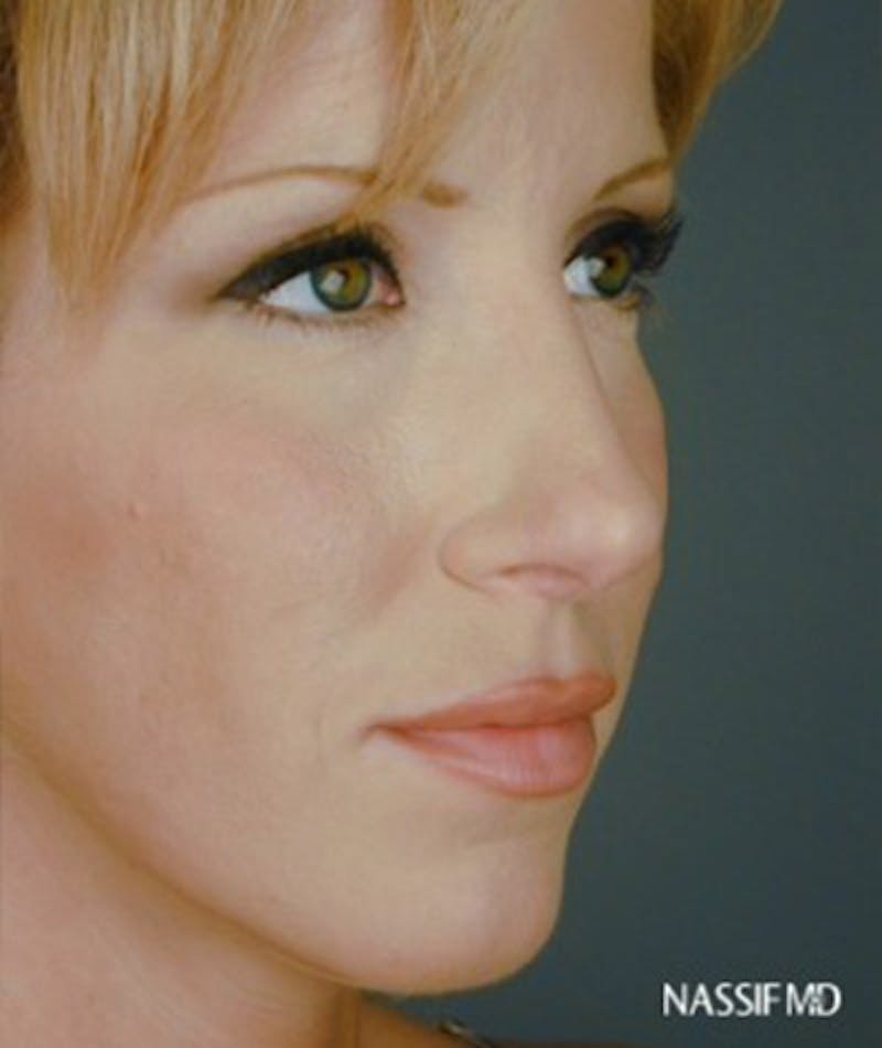 Primary Rhinoplasty Before & After Gallery - Patient 108171681 - Image 6