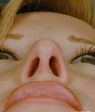 Primary Rhinoplasty Before & After Gallery - Patient 108171681 - Image 8