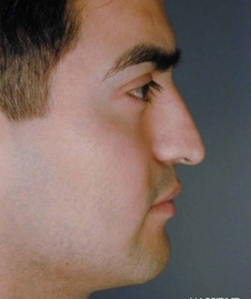 Primary Rhinoplasty Before & After Gallery - Patient 108171682 - Image 1