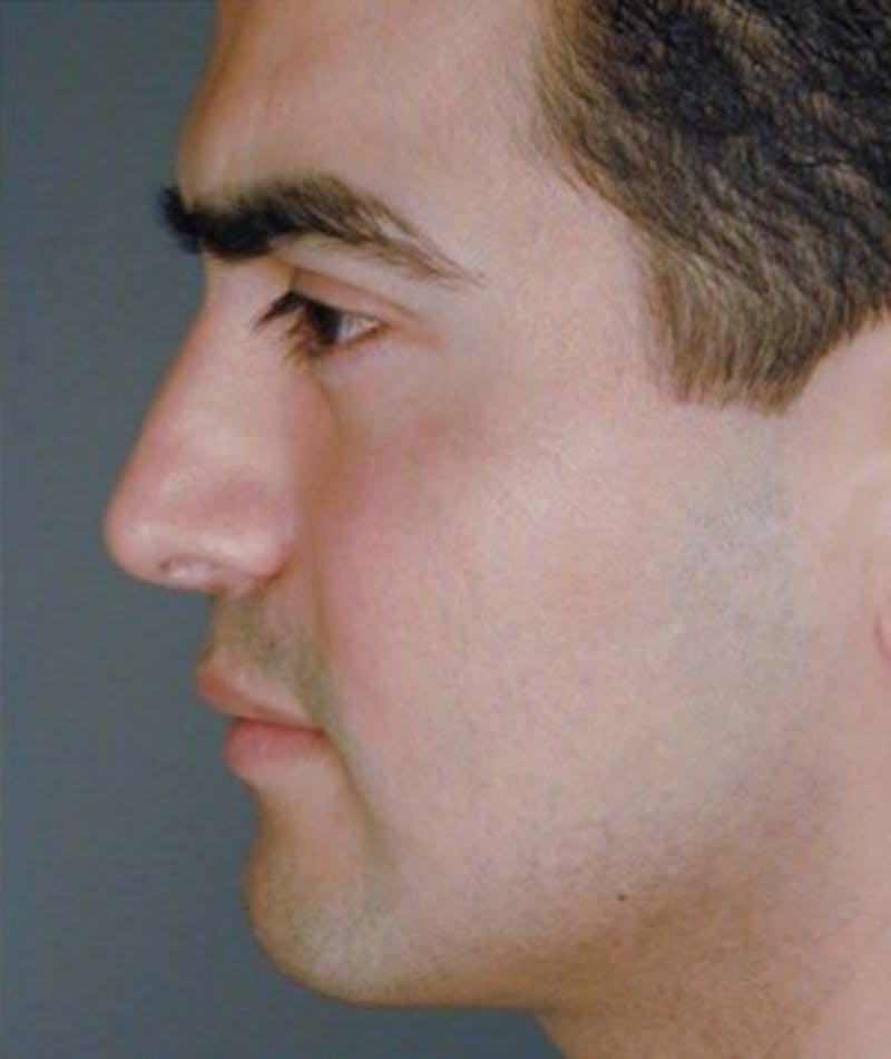 Primary Rhinoplasty Before & After Gallery - Patient 108171682 - Image 2