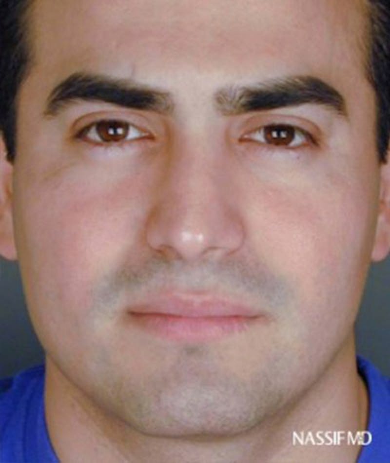 Primary Rhinoplasty Before & After Gallery - Patient 108171682 - Image 4