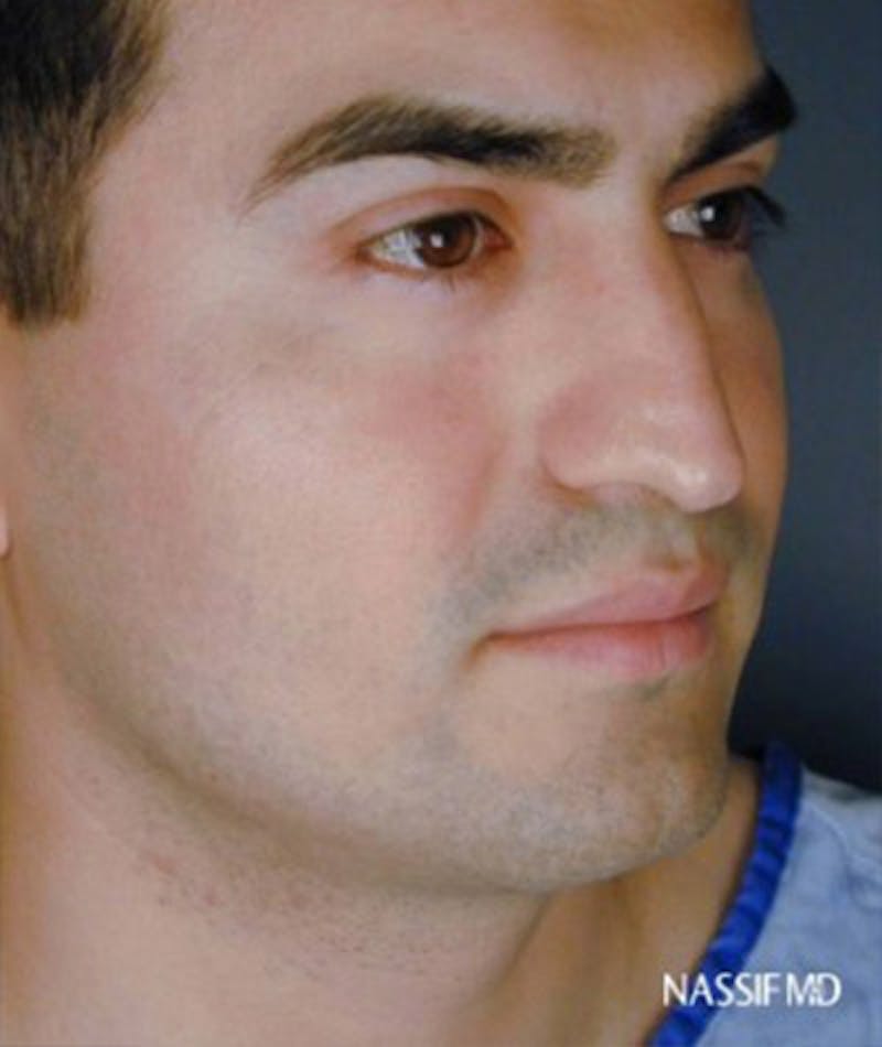 Primary Rhinoplasty Before & After Gallery - Patient 108171682 - Image 5