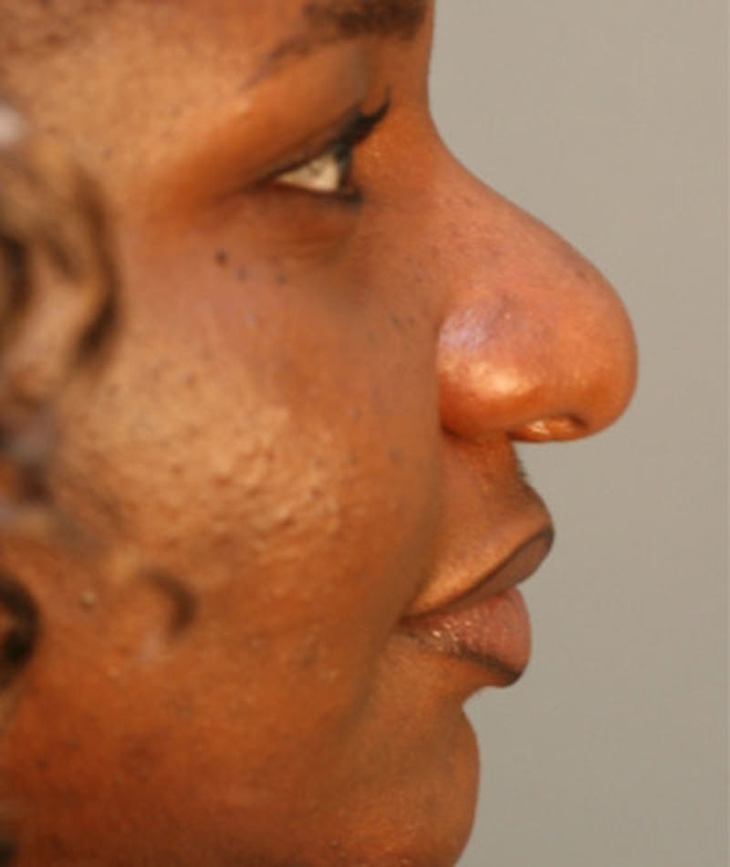 Primary Rhinoplasty Before & After Gallery - Patient 108171683 - Image 1