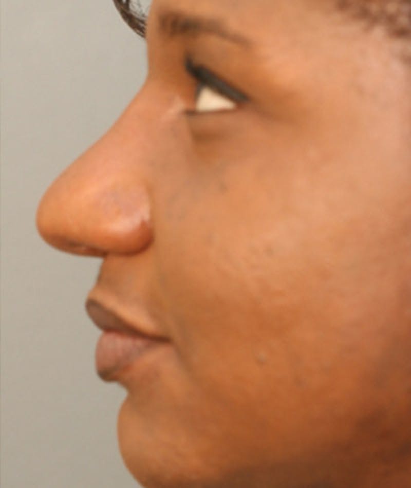Primary Rhinoplasty Before & After Gallery - Patient 108171683 - Image 2